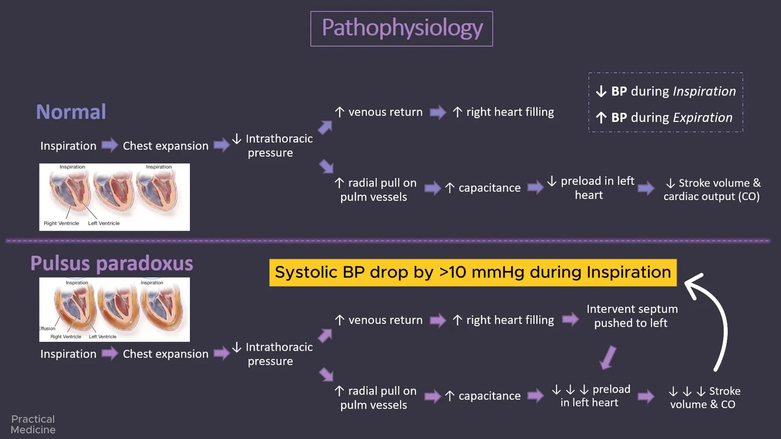 מצבים רפואיים שיכולים לגרום לפולסוס פרדוקסוס
